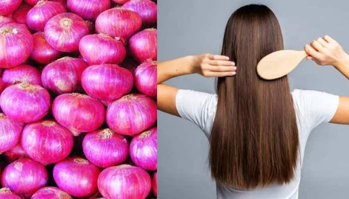 Home Remedies of Dandruff : प्याज के रस से इन उपायों से पाये डैंड्रफ से छुटकारा