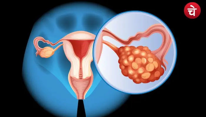 Ovary Health