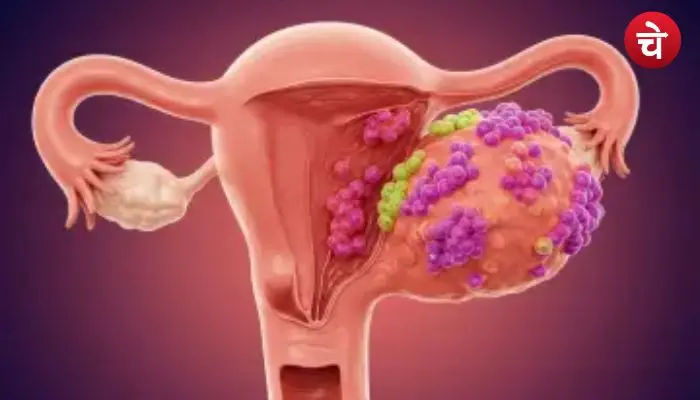 ovarian cyst