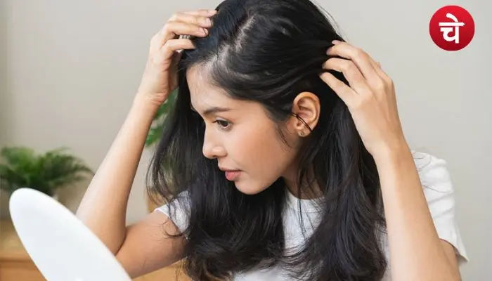 dandruff hair