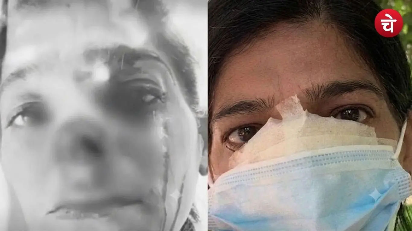 Woman suffers severe nose injury after being attacked by a beggar during Govardhan Parikrama